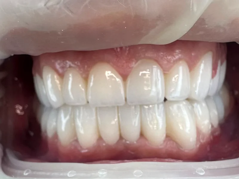 Zâmbet perfect aliniat și alb obținut prin fațete dentare ceramice E-max la Galadent