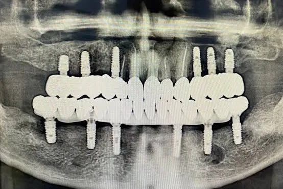 Cât costă un implant dentar în Râmnicu Vâlcea și cum îl alegi?